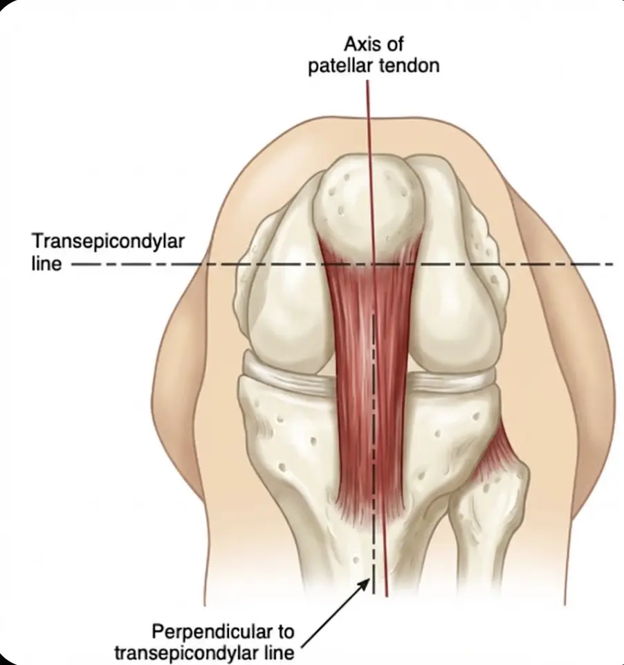 Tubercle Sulcus Angle Orthopedic Special Test